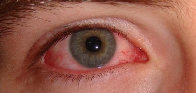 seha 40 1465148774 - علاج رمد العين للأطفال