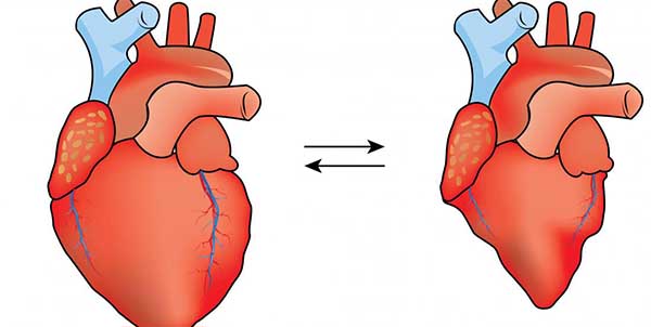 صمام القلب وكيفية علاجه - علاج ارتخاء صمام القلب