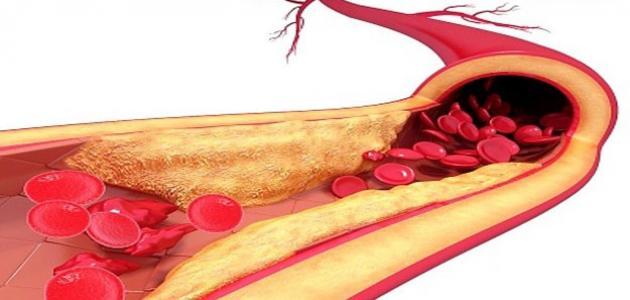 الدهون في الدم - اسباب زيادة الدهون في الدم